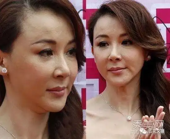 这些7大女明星整容失败,越变越丑!萧蔷脸肿嘴歪嘴斜变「僵尸新娘」!