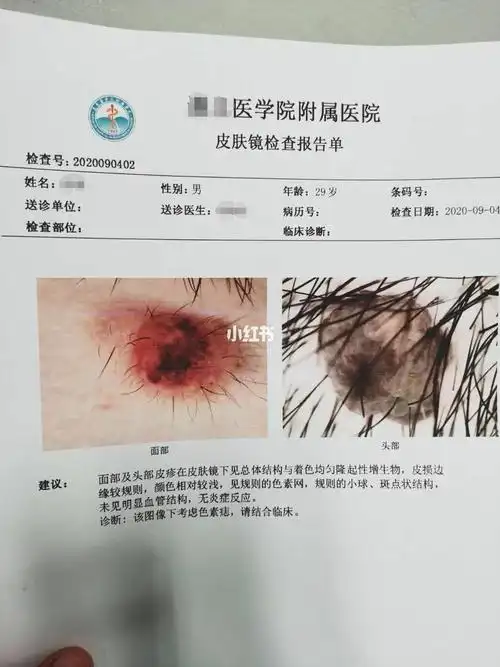 第一次知道还是皮肤镜这东西