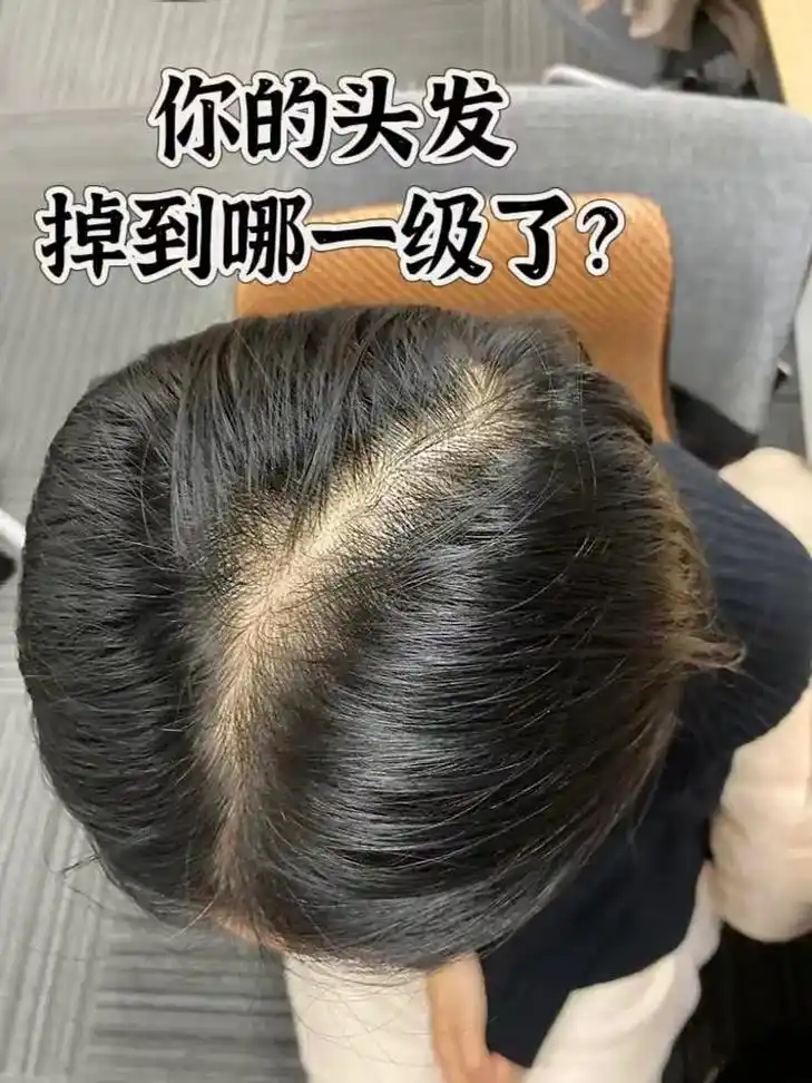 05脱发等级测试,你的头发掉到哪一级了?02对比图片,根据专 - 抖音