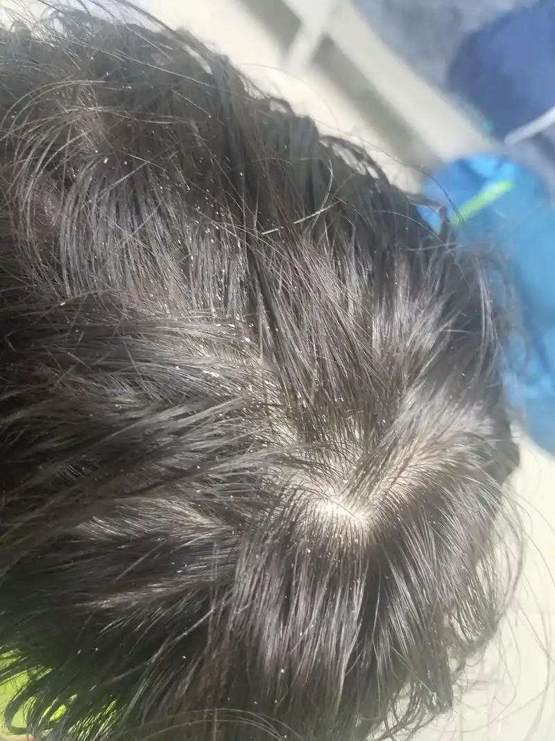 头皮型银屑病:发病背后的真相 头皮型银屑病给很多患者带来了不小的