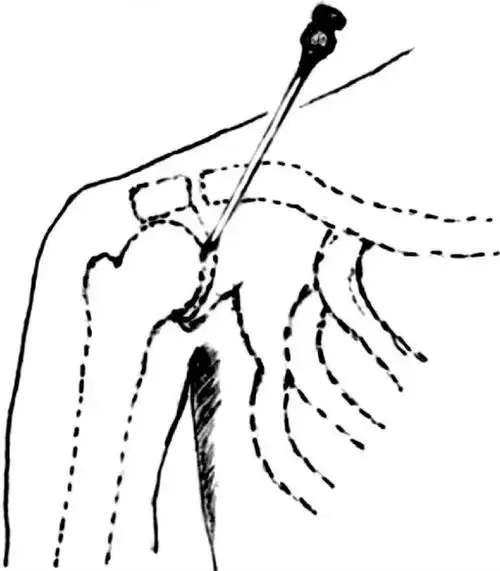 肩关节轻度外展,针尖沿肩峰下方,呈水平方向(与肩峰成直角),刺入关节.
