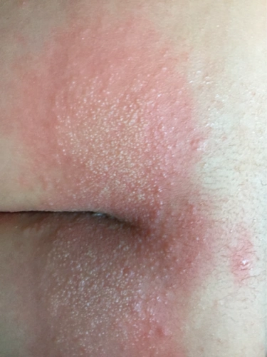 宝宝屁股这突然长了一大片这样的东西,去药店拿了药但是抹了好像没