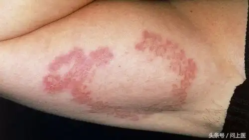图解10种常见的糖尿病皮肤并发症