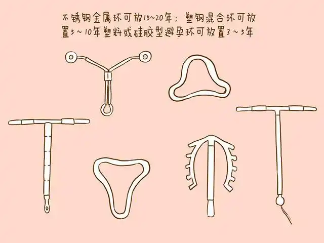 常见避孕环类型