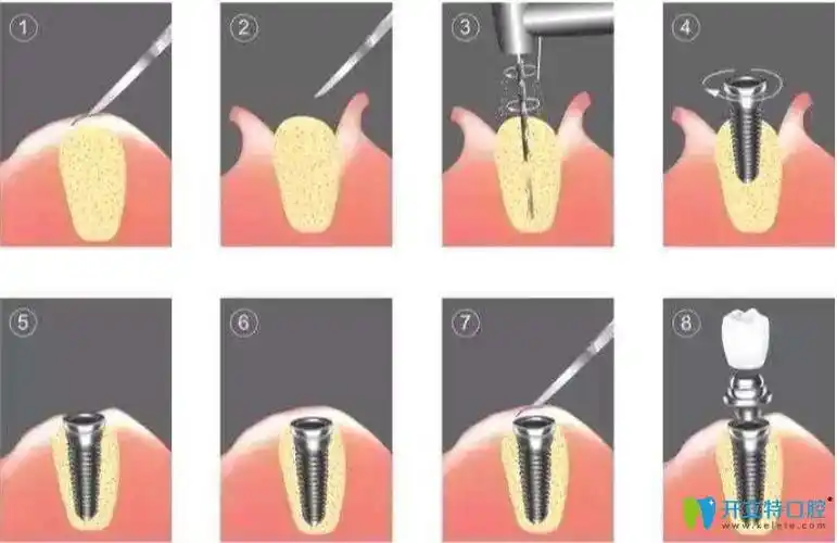 普通种植牙步骤