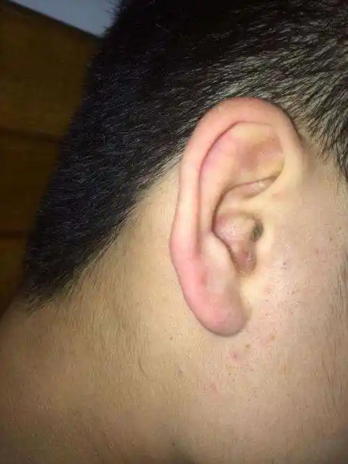 耳朵上长了个硬包-耳朵上面鼓起来一个包