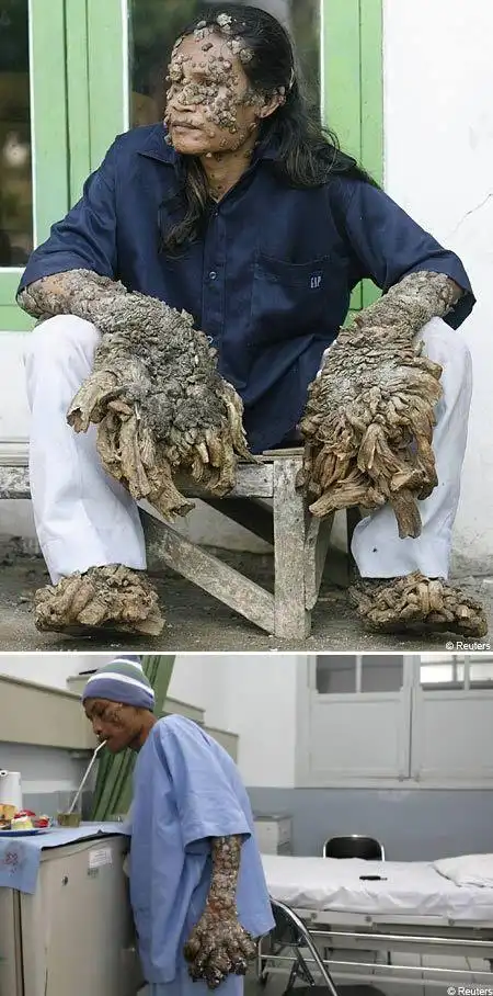 7大最奇怪的皮肤病 银中毒使皮肤变蓝(组图)