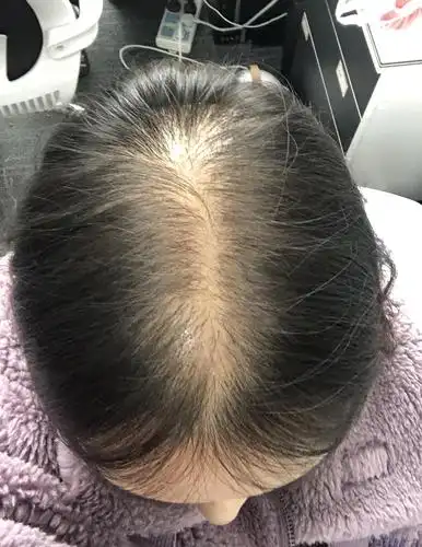 脂溢性脱发治疗记录(更新对比图)