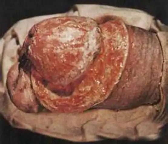 梅毒三个时期的症状是这样的