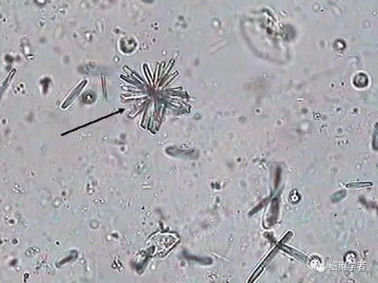 ▼ 2017505:磷酸钙结晶