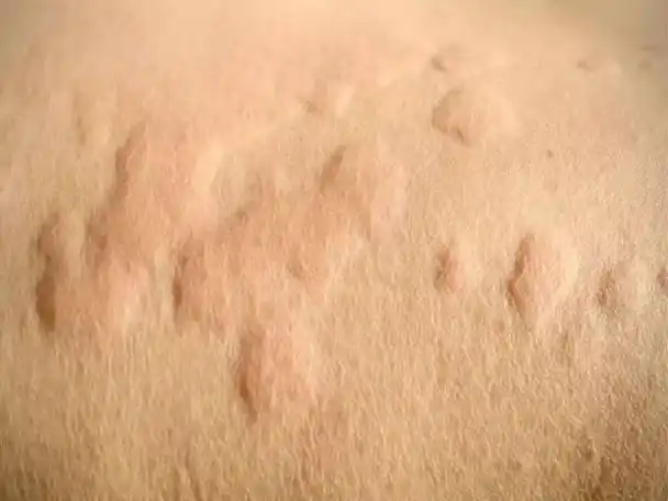 过敏性皮炎的预防和护理 - 母婴知识