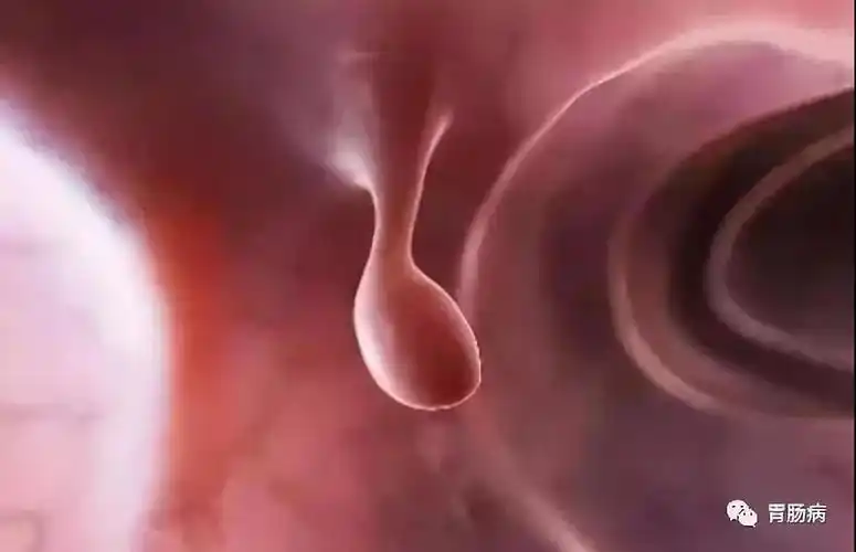 我叫"息肉",是癌的近亲!