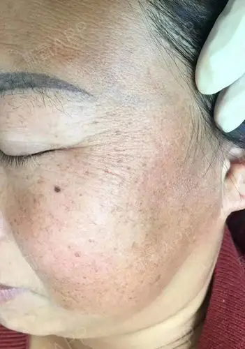 皮秒我的检测出来说是混合斑,有点类似黄褐斑这种,_圈子-新氧美容