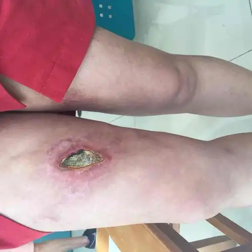 就有了今天我看到的下图很明显,抽脂区域已经感染并呈现坏死性筋膜炎