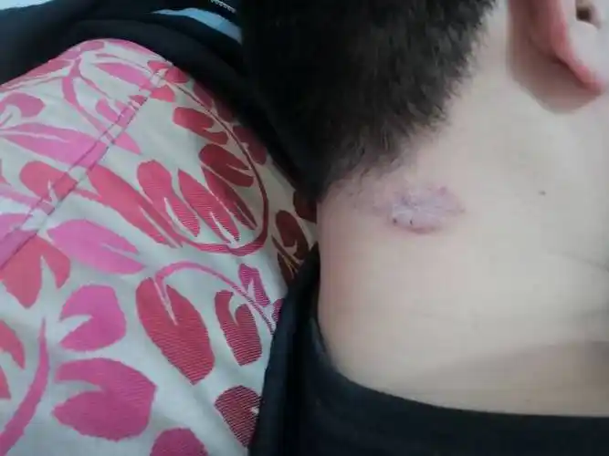 脖子起癣,,,,,,,,,,,,,,,,,,,,11,,,,,