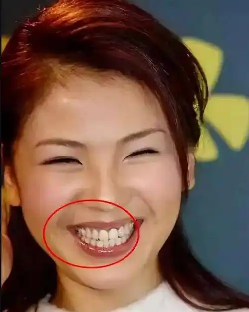 整个手术后,刘涛的牙齿非常白,她脸上最突出的部分是她的牙齿.