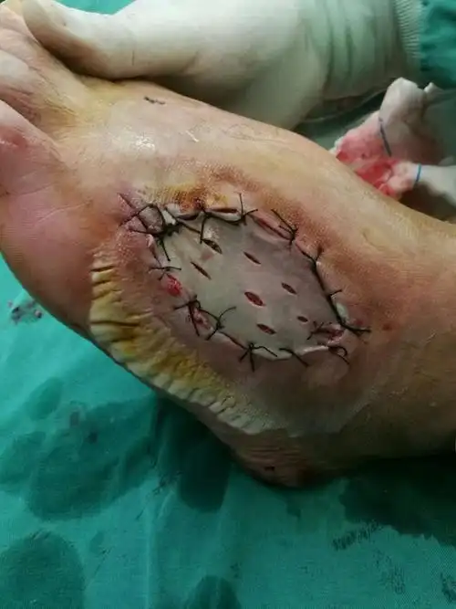 11床 左足外伤后足背皮肤坏死缺损,创面不愈合