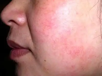 根除面部红血丝