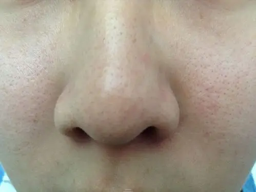 去黑头收缩毛孔用什么产品好