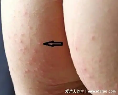 手足口病刚开始的图片,身上长轻微小红点是初期症状(不容小觑)