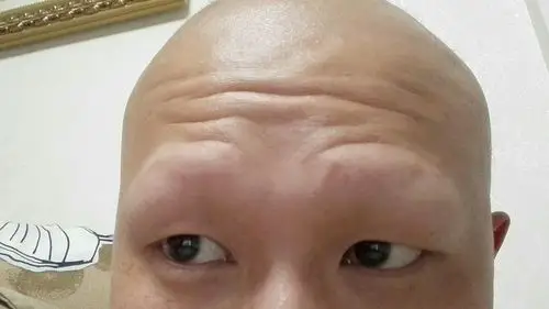 我的头发眉毛全部脱光了 去医院也查过了 包括艾滋病 性病全套 梅毒