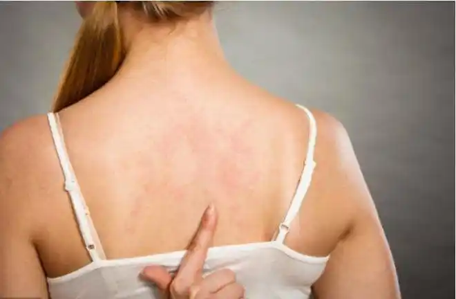 皮肤瘙痒反反复复好不了,自查一下这六个原因,对症下药才有用