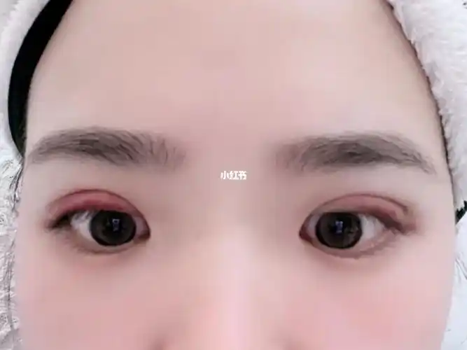 埋线双眼皮第二天,感觉跟想象的不太一样.不知道恢复了会怎么样,担心