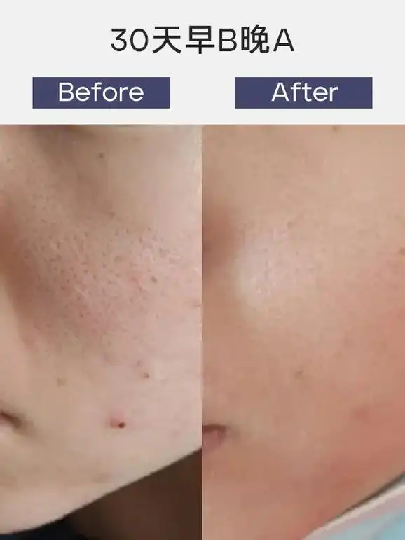 细腻皮肤 告别毛孔粗大!茜儿,油痘肌,毛孔粗大,肤色暗沉,从 - 抖音