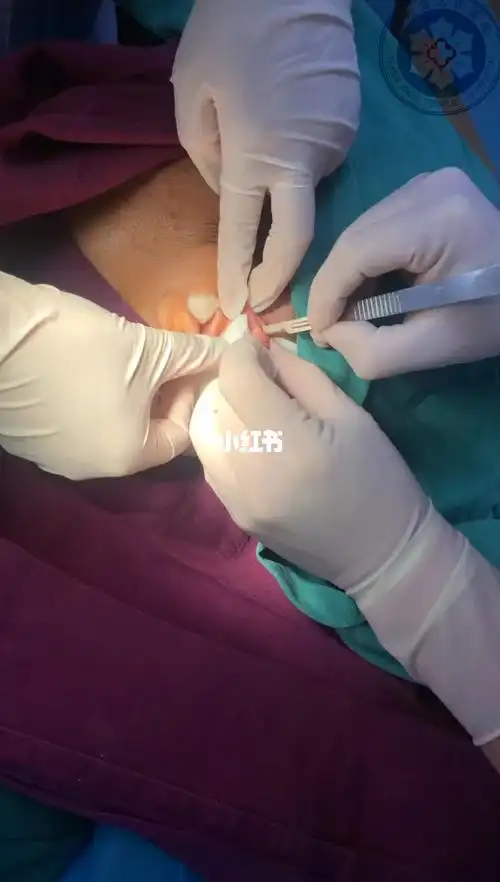 没错这是外耳廓小囊肿手术