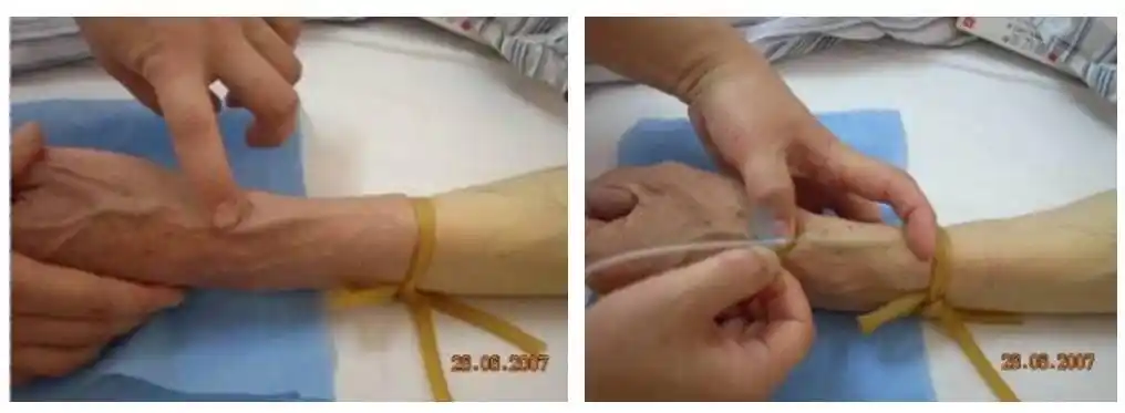 穿刺法:绷紧上下皮肤,固定血管后行旁刺.部位:手腕部及足踝腕部.