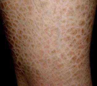 丑角样鱼鳞病发病原因是什么