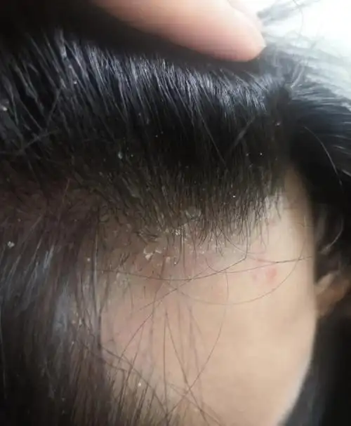 我并不是天生的雪花头,只怪我前几年胡乱用洗发水,头上的头屑像是被