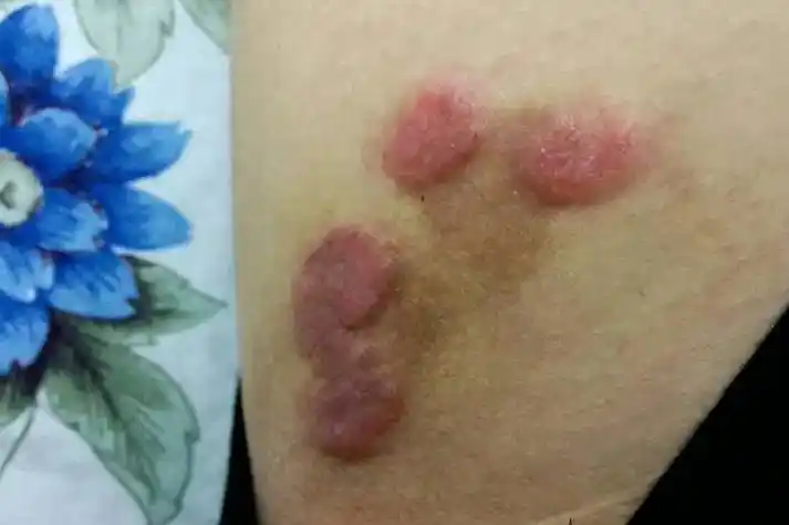 大腿淋巴肿瘤图片大全