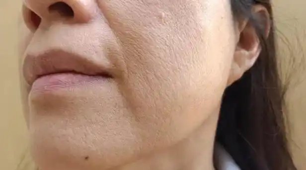 脸干爆皮怎么快速解决