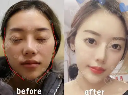 重庆华美做自体脂肪填充面部臀部的技术水平都不在话下