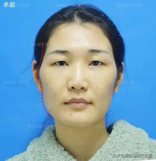 错,颧骨高也好看,不好看是颧骨高耸_脂肪_脸型_线条