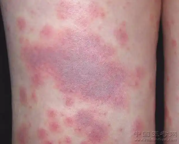 史上最全的皮肤病图谱,吐血整理!