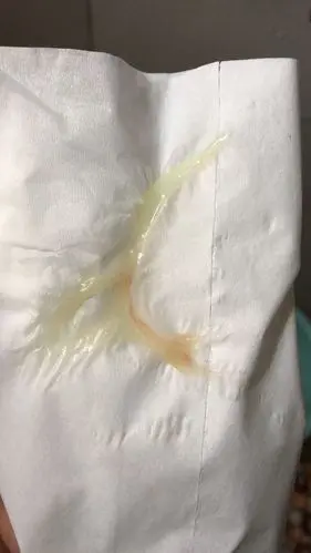 383,上厕所白带里面有一点红血丝,请问是见红了吗?