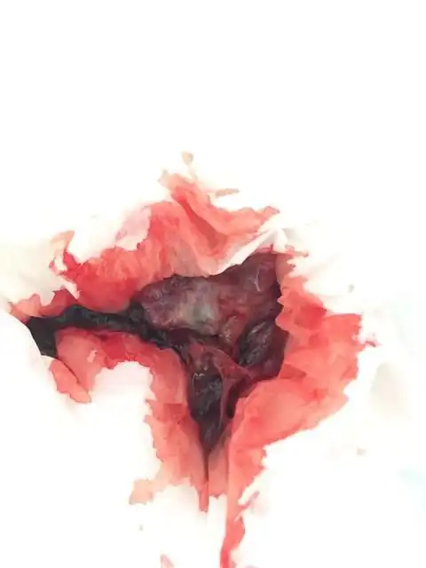 做完阴超自然流产了 胎儿都成型了