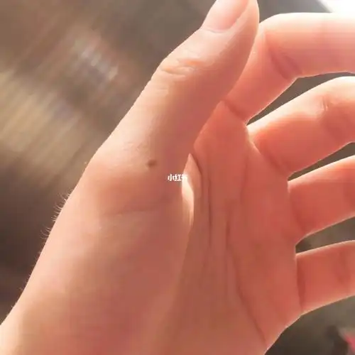 左手大拇指长痣小时候长的越长越大颜色越浅痣