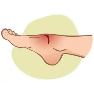 流血伤口例证第一援助人, 高加索, 站立的旁边看法, 以脚损伤, 切开与