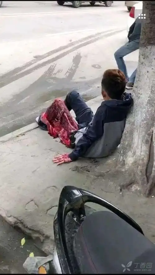 大货车碾压造成的脱套伤