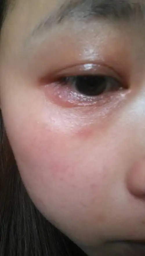 眼睛周围长红疹,眼睛干痒,不知道试不是手抓坏了,怎么办啊?好吓人哦