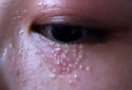 眼睛周围长了很多小疙瘩,身上胸前也有,不知道是什么,怎么去掉啊