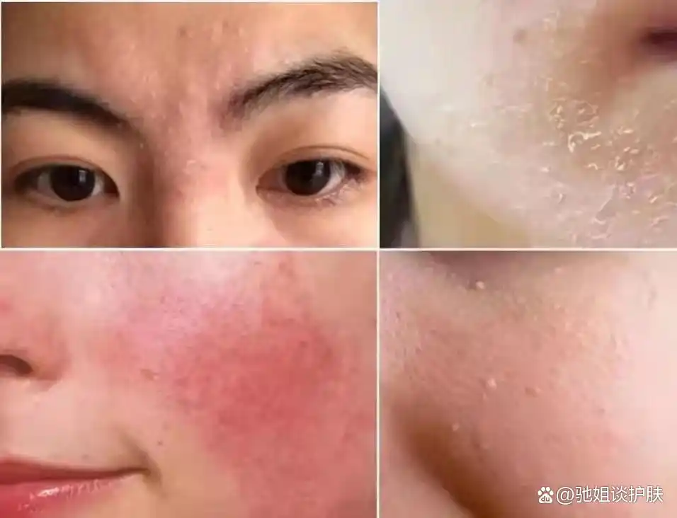 皮肤屏障功能受损如何修复