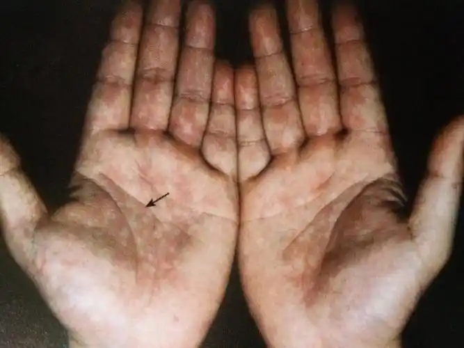 肝区掌色的改变与肿瘤有什么特殊关系