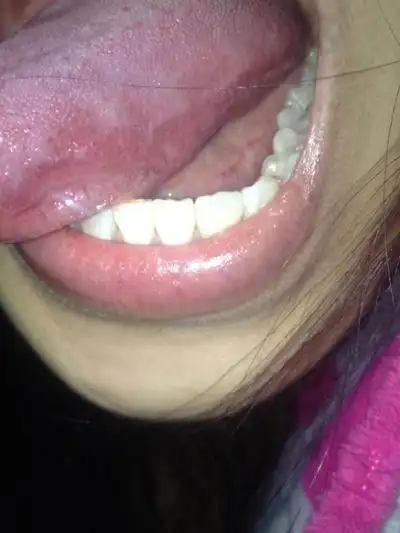 艾滋病舌头图片 (56)