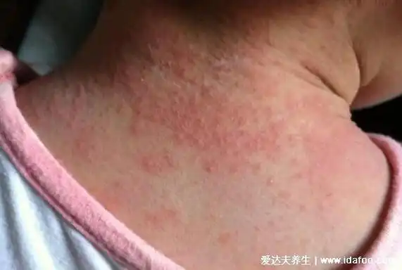 湿疹图片初期症状图片,四种类型的湿疹干燥型最痒(不要抓小心感染)