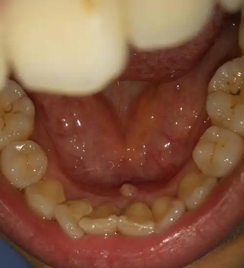 牙龈上长了一个白白的小包,这是什么了吗?