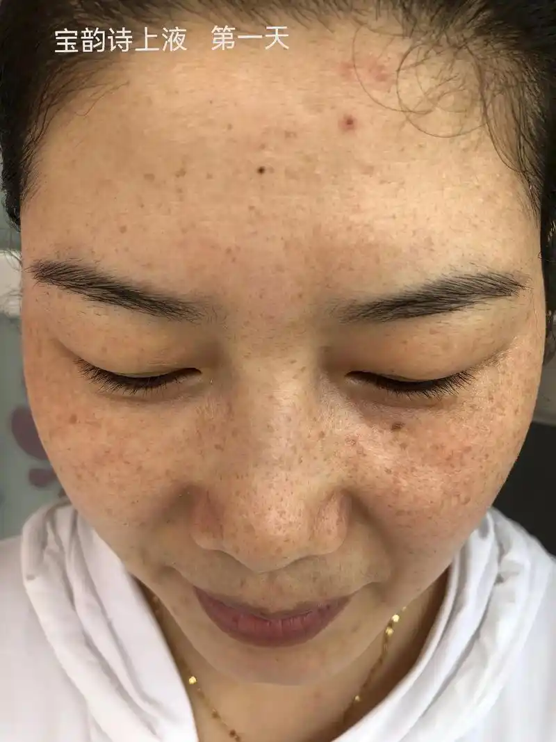 宝韵诗上液第一天,到十四天的毒素垃圾排出,之前皮肤雀斑,过敏 - 抖音